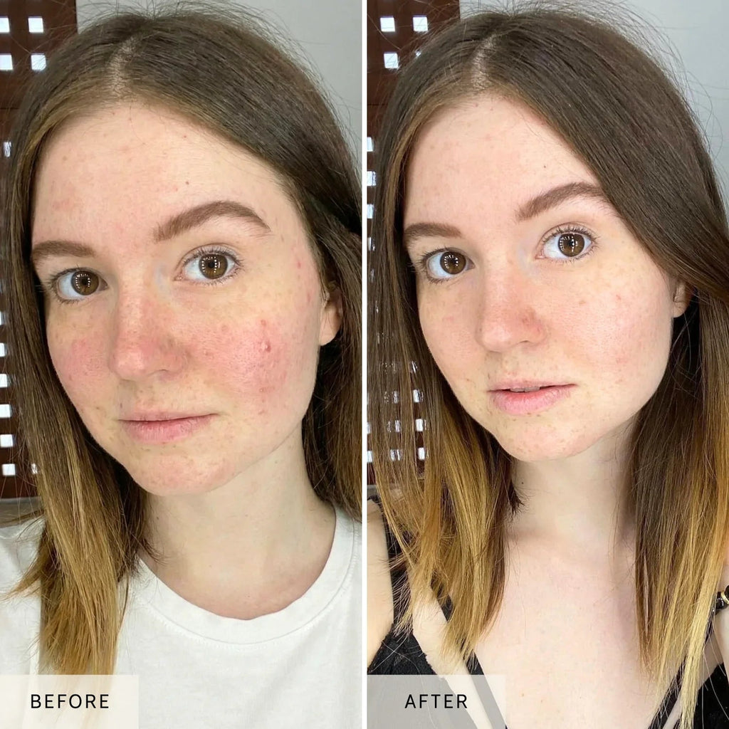 NiceBeam LED Red Light Therapy Face Mask | At-Home Skincare