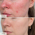 NiceBeam LED Red Light Therapy Face Mask | At-Home Skincare